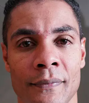 Sensacao Na Pele